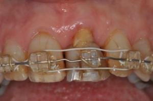 braces and orthodontics